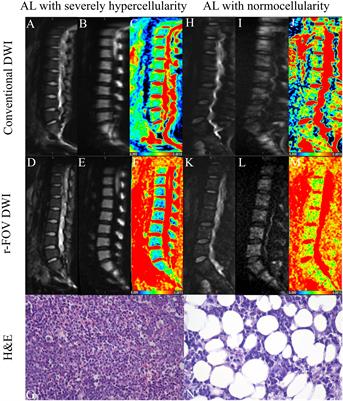 Comparison of reduced field-of-view DWI and conventional DWI techniques for the assessment of lumbar bone marrow infiltration in patients with acute leukemia